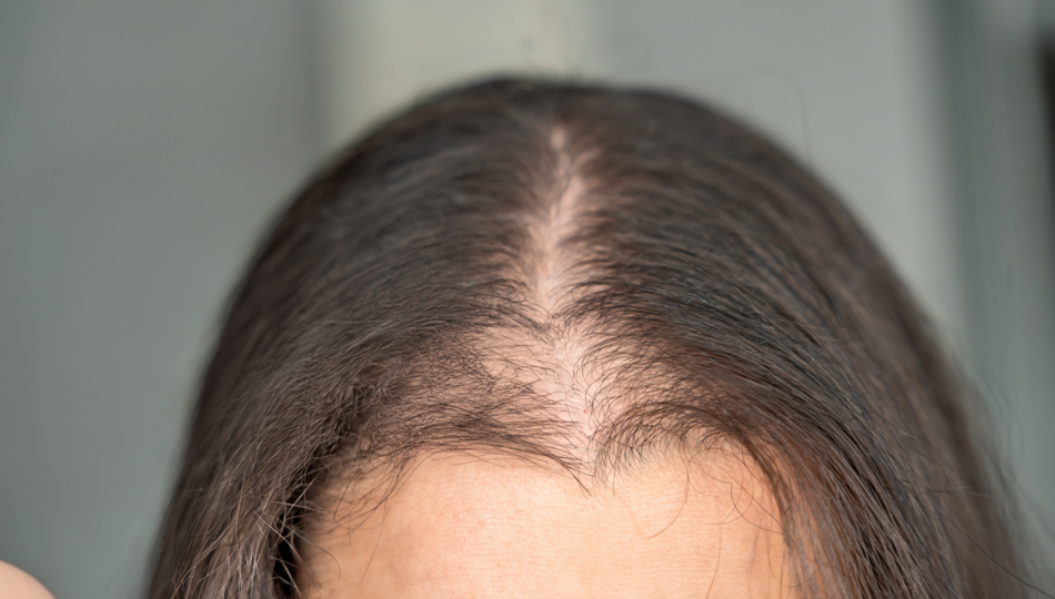 alopecia