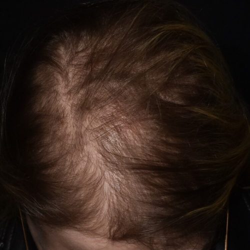 antes caso cabelo alopecia androgenetica