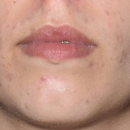 Rosto com acne inflamatória, pápulas e pústulas na face, antes do tratamento na Clínica Dermage