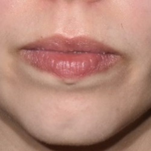 O mesmo rosto após o tratamento da acne, com redução das lesões inflamatórias e da vermelhidão