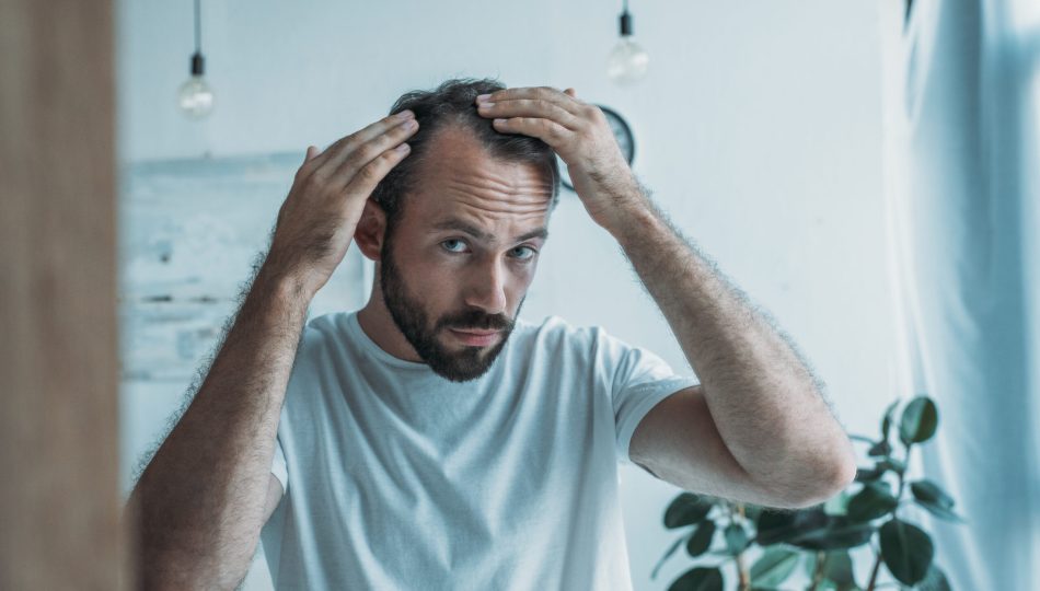 man with alopecia