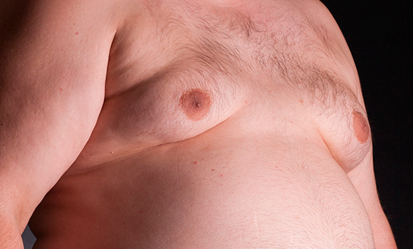 Gynecomastia / Male Breats Excess