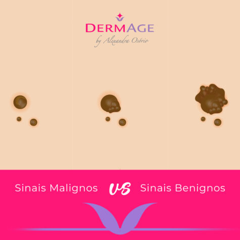 Sinais Malignos vs Sinais Benignos