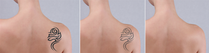 Remoção de Tatuagens – Tecnologia lazer que redesenha a sua história